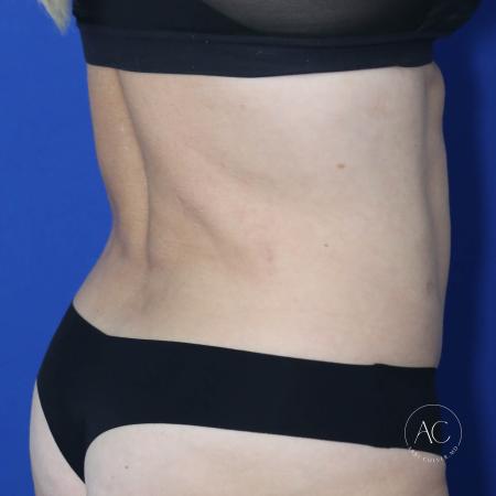 Before image 4 Case #128771 - Abdominoplasty
