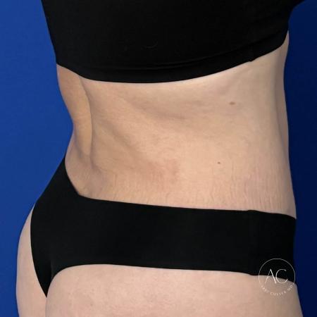 After image 4 Case #128771 - Abdominoplasty