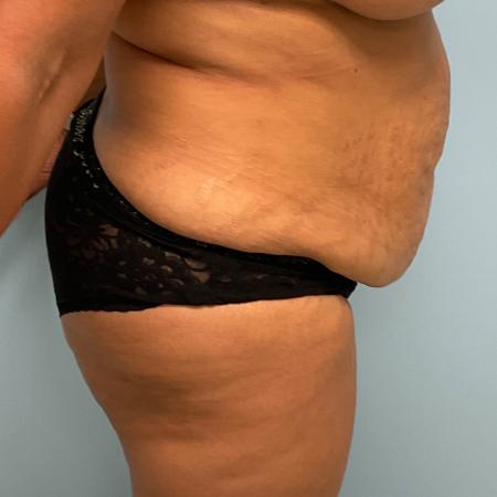 Before image 2 Case #128716 - 50 y.o female with Tummy Tuck, BBL, & Lipo