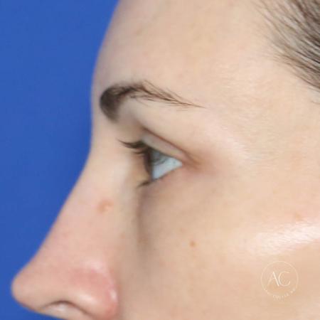 Before image 3 Case #128766 - Upper blepharoplasty