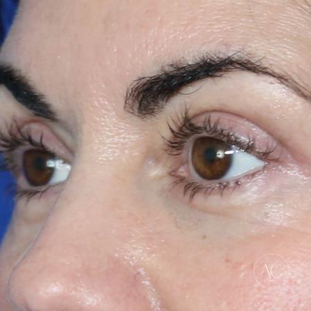 After image 2 Case #128786 - Upper blepharoplasty