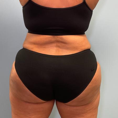 After image 3 Case #128716 - 50 y.o female with Tummy Tuck, BBL, & Lipo