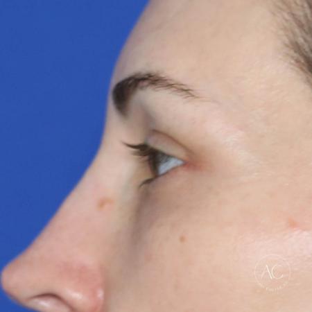 After image 3 Case #128766 - Upper blepharoplasty