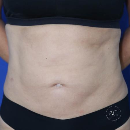Before image 1 Case #128771 - Abdominoplasty