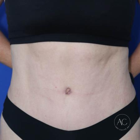 After image 1 Case #128771 - Abdominoplasty