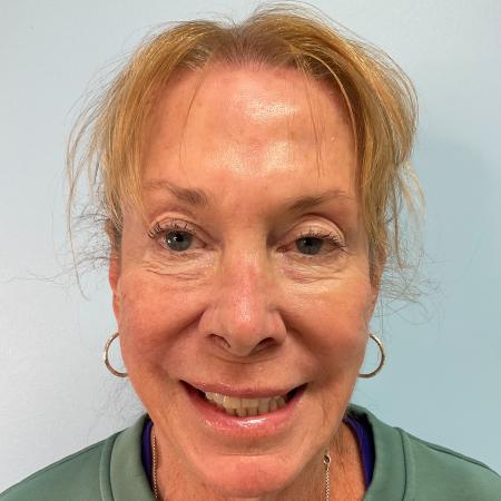 After image 1 Case #129006 - 71 y.o. female with Botox and Filler