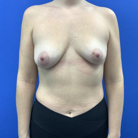 Before image 1 Case #129436 - Breast Augmentation, Subfascial