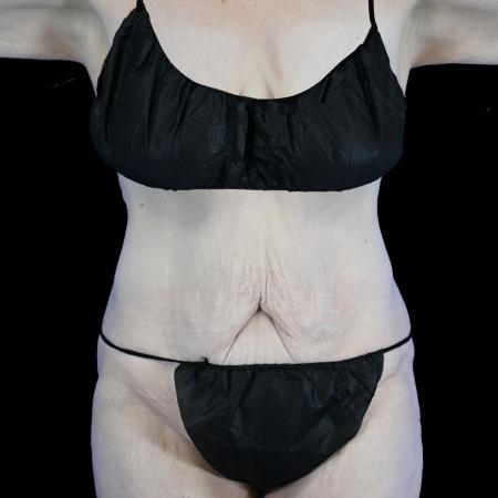 Before image 1 Case #129156 - High-Definition Lower Body Lift
