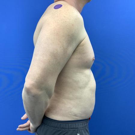 After image 3 Case #129431 - Liposuction