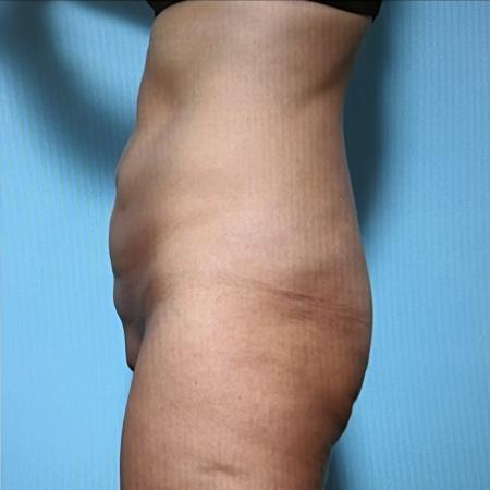 After image 3 Case #128296 - Liposuction 