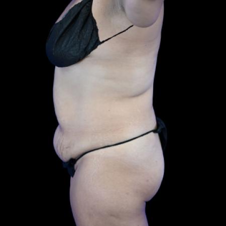 Before image 3 Case #129136 - Tummy Tuck