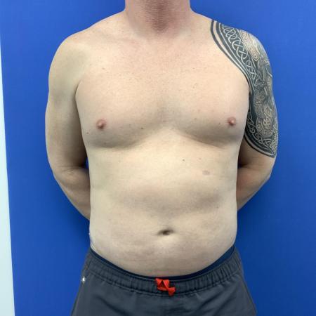 After image 1 Case #129431 - Liposuction