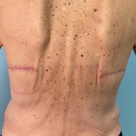 After image 2 Case #129166 - 63 y.o. female with Bra Line Lift