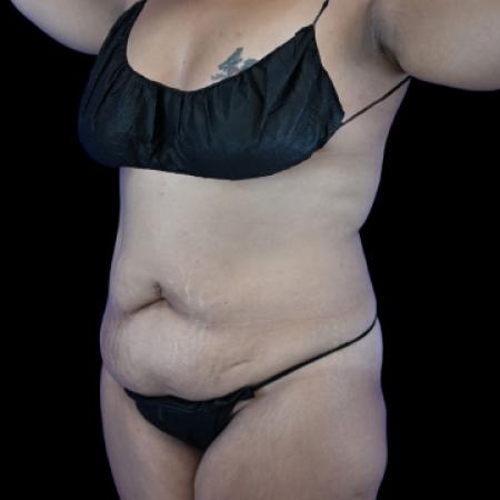 Before image 2 Case #129136 - Tummy Tuck