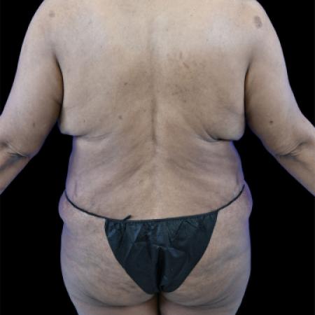 Before image 3 Case #129141 - Tummy Tuck