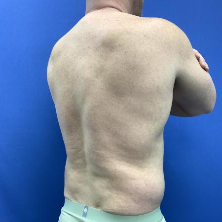 Before image 2 Case #129431 - Liposuction