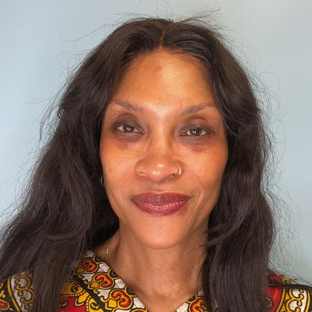 After image 1 Case #129446 - 53 y.o. female with Belotero and Versa Fillers