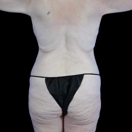 Before image 4 Case #129156 - High-Definition Lower Body Lift