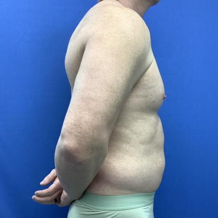 Before image 3 Case #129431 - Liposuction