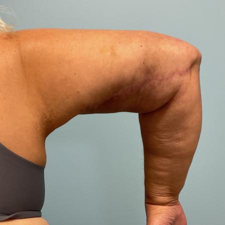 After image 2 Case #129191 - 58 y.o. female with Brachioplasty and Liposuction