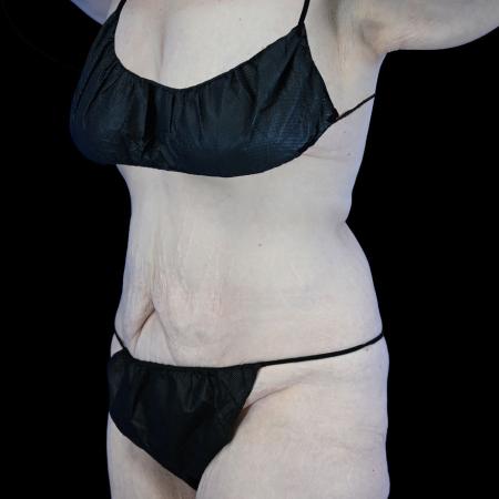 Before image 2 Case #129156 - High-Definition Lower Body Lift