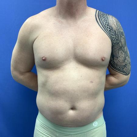 Before image 1 Case #129431 - Liposuction