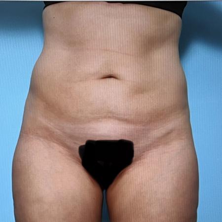 After image 1 Case #128296 - Liposuction 