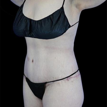 After image 2 Case #129156 - High-Definition Lower Body Lift