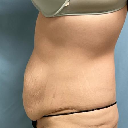 Before Case #129056 - 33 y.o. female w/ Tummy Tuck, Lipo and BBL