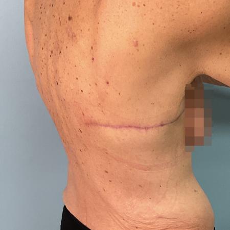 After image 1 Case #129166 - 63 y.o. female with Bra Line Lift