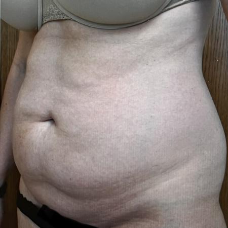 Before image 2 Case #128296 - Liposuction 