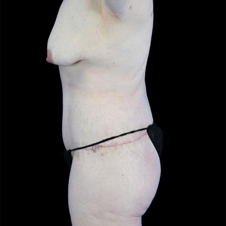 After image 3 Case #129156 - High-Definition Lower Body Lift