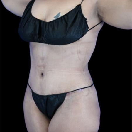 After image 2 Case #129136 - Tummy Tuck