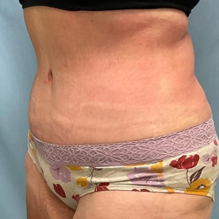 After image 2 Case #129086 - 50 y.o. female with Tummy Tuck