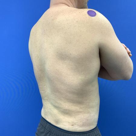 After image 2 Case #129431 - Liposuction