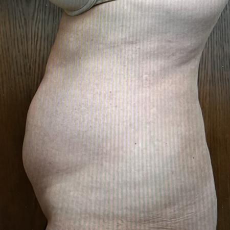 Before image 3 Case #128296 - Liposuction 
