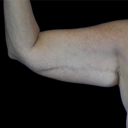 Before image 1 Case #129131 - Revision arm lift (brachioplasty)