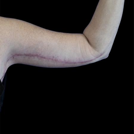 After image 3 Case #129131 - Revision arm lift (brachioplasty)