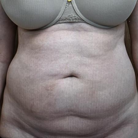 Before image 1 Case #128296 - Liposuction 