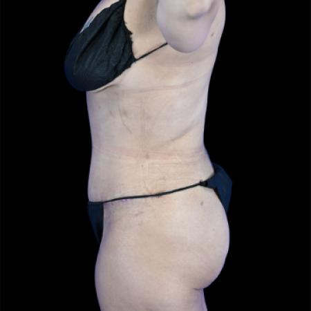 After image 3 Case #129136 - Tummy Tuck