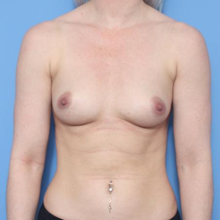 Before image 1 Case #129441 - Breast Augmentation