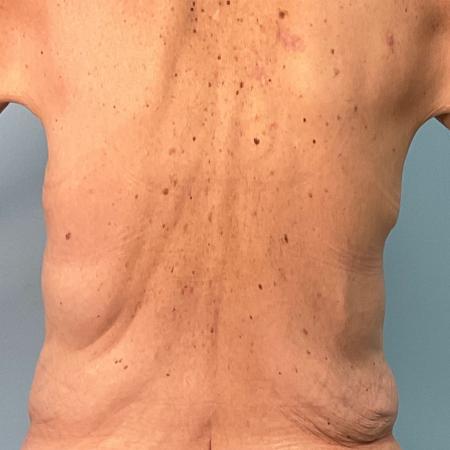 Before image 2 Case #129166 - 63 y.o. female with Bra Line Lift