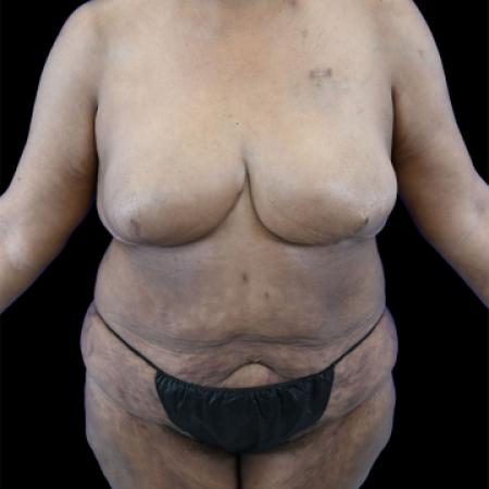 Before image 1 Case #129141 - Tummy Tuck