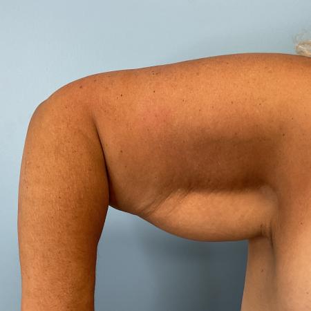 Before image 3 Case #129191 - 58 y.o. female with Brachioplasty and Liposuction