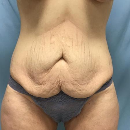 Before Case #129056 - 33 y.o. female w/ Tummy Tuck, Lipo and BBL