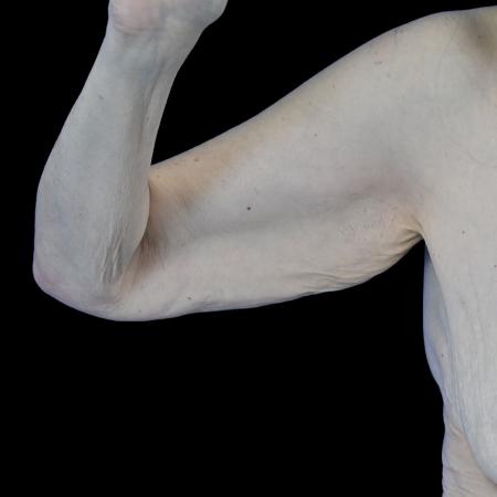 Before image 1 Case #129146 - Arm lift with forearm reduction