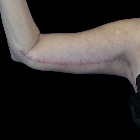 After image 1 Case #129131 - Revision arm lift (brachioplasty)