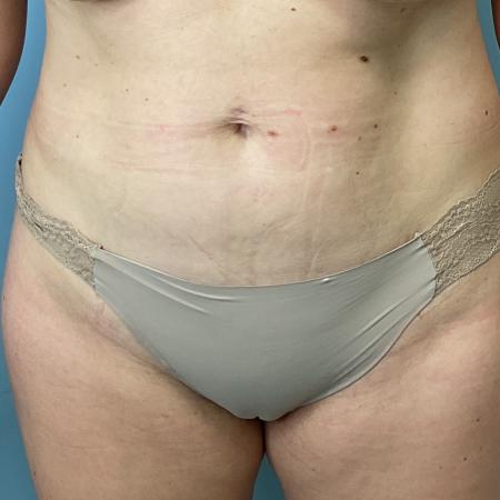 Before image 1 Case #129341 - 40 y.o. female with liposuction of abs 