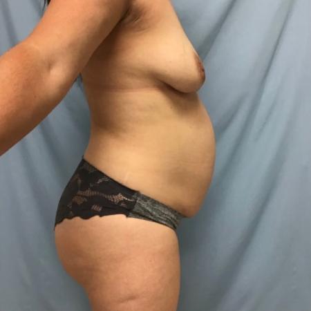 Before image 2 Case #129106 - 39 y.o. female w/ Tummy Tuck, Lipo & Fat Transfer