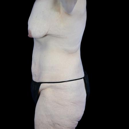 Before image 3 Case #129156 - High-Definition Lower Body Lift